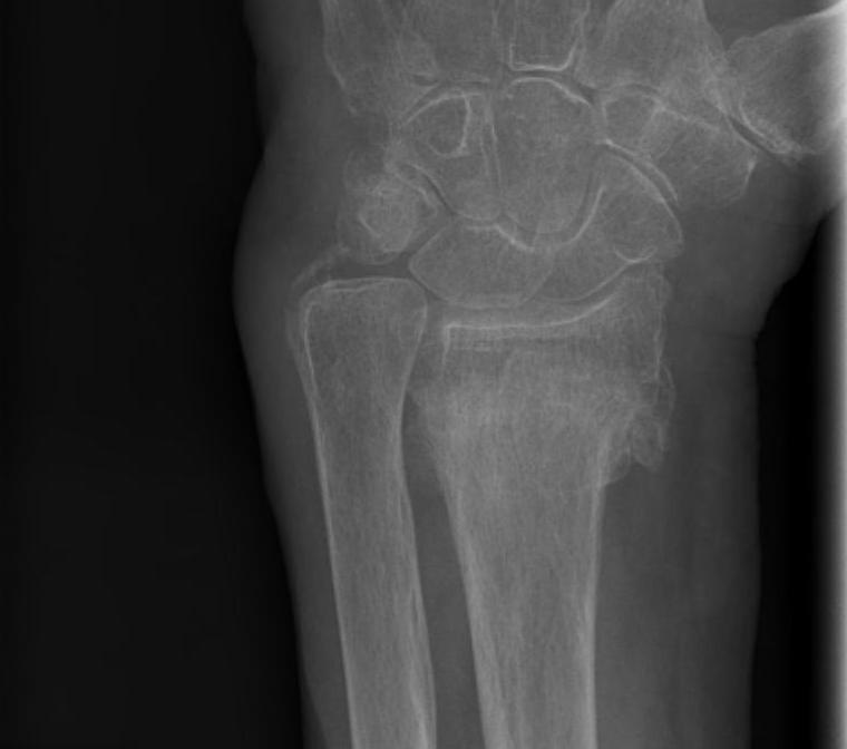 Radial Malunion Shortening